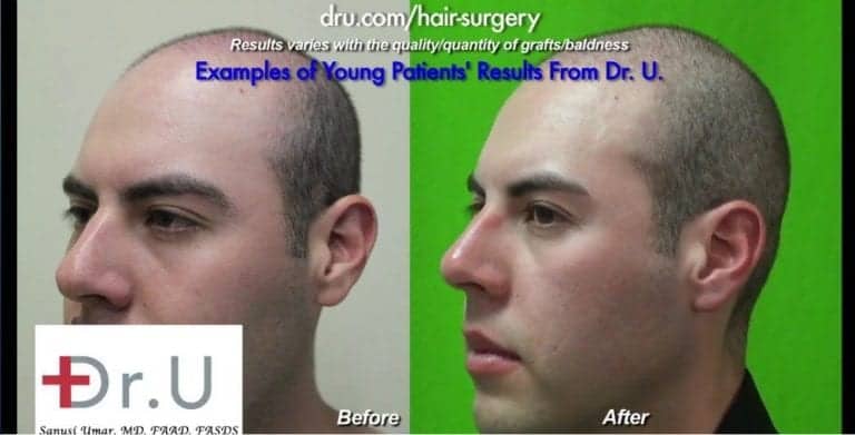 Torrance patients can get a hair transplant at age 23 with the right donor quantity