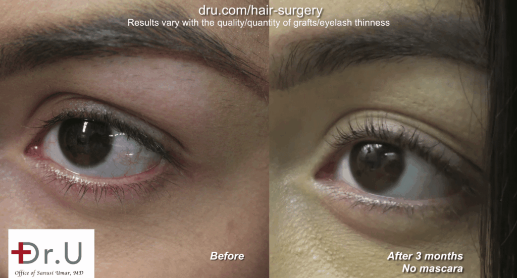 Dr. U was able to perform this BHT eyelash restoration with leg hair. These are the extraordinary results.*