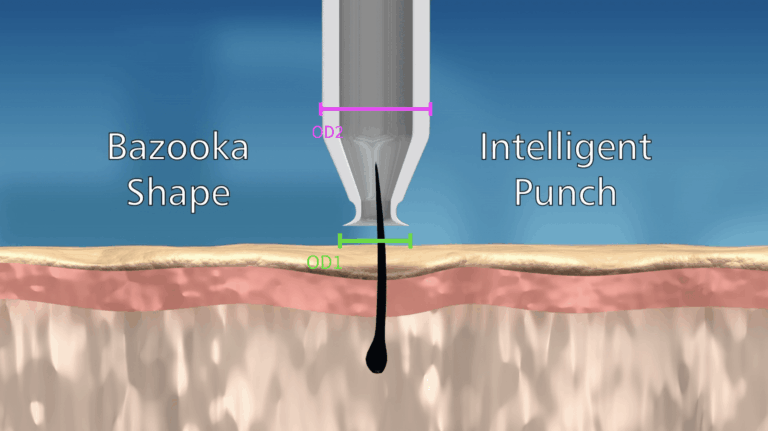 The bazooka shape of the roomed inner chamber allows for the collection of bulkier grafts without increasing wound size.