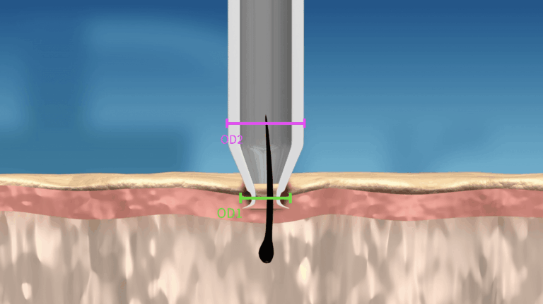 The distal cutting diameter at the mouth of the punch makes an initial incision the same diameter as OD1.