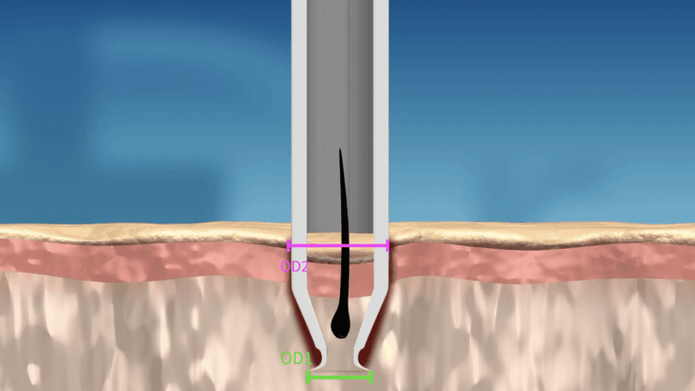 As the body of the punch widens, the opening of the wound is gently stretched to OD2.