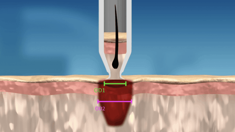 When the punch penetrates into the skin, the wound is gently stretched to the diameter of the lumen's widest point.