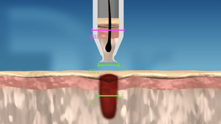 After the punch has been removed, the cavity of the wound left behind shrinks back to the original circumference of the smaller distal tip.