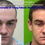 young-patient-hair-transplant-150x150