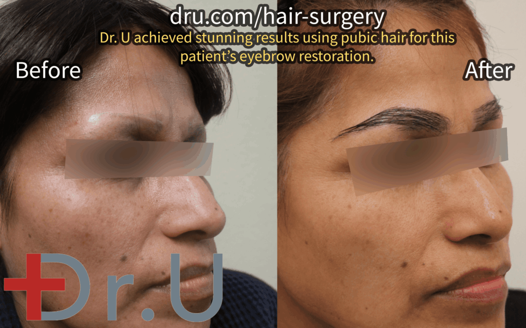 One Hollywood patient's eyebrow transplant before and after photos.*
