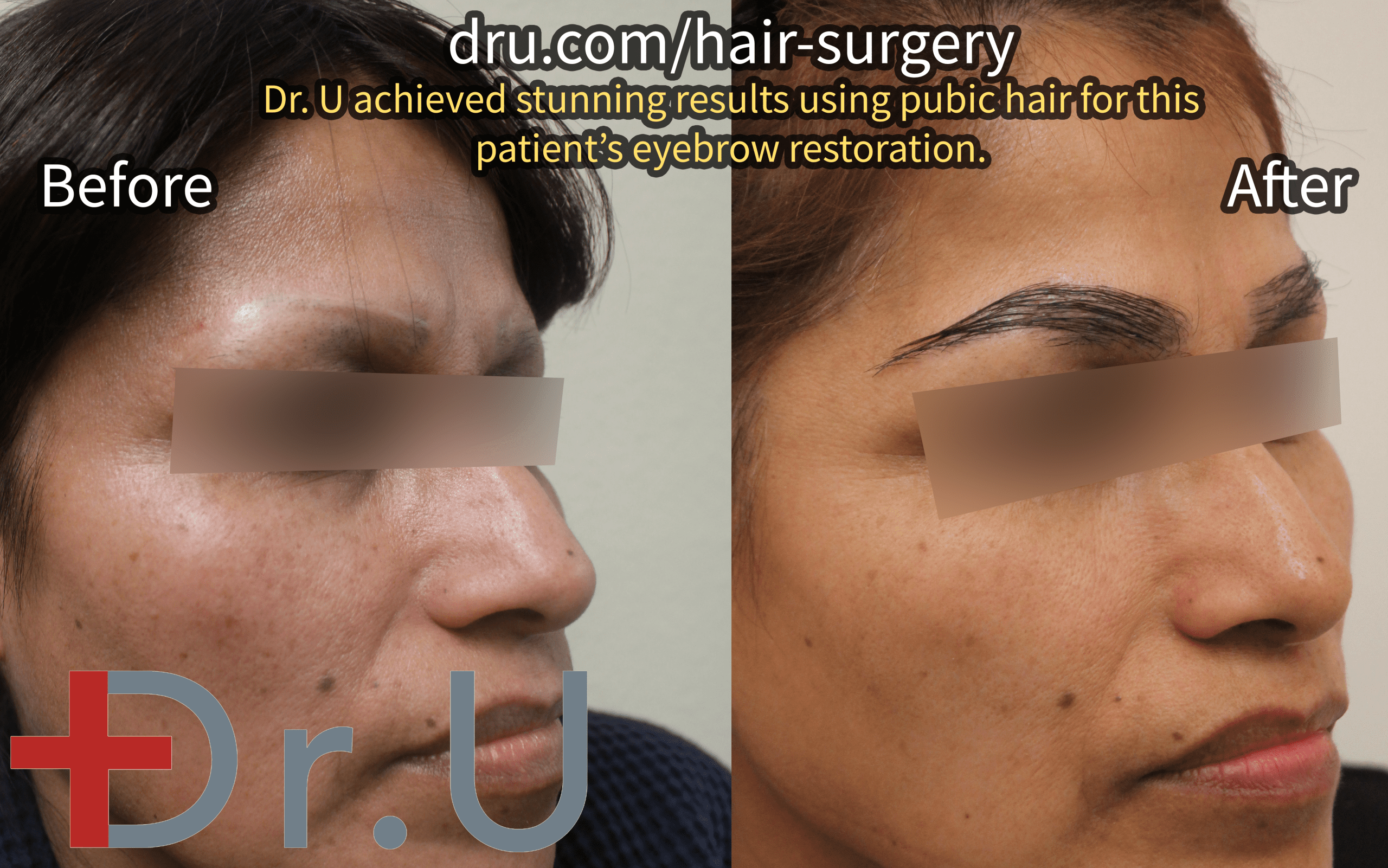 The patient’s eyebrow scar repair before and after photos.* The patient’s eyebrow scar repair before and after photos.*