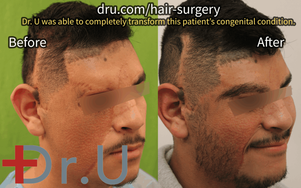 This patient came to Dr. U looking to construct his right eyebrow and the right side of his beard. Donor sources utilized include the scalp, nape, and legs.*