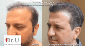 In this Q&A video, Dr. Umar discusses the issue of poor growth yield after a hair transplant as well as the most common factors which cause this.