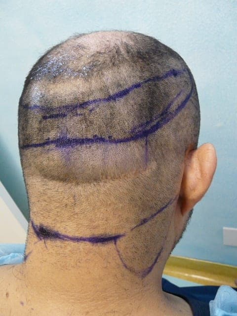 Patient with NW 4-5 level hair loss (Right Side view), FUE Shave test negative, nape and periauricular hair shows a precipitous fall from the mid occipital zone in terms of density, and hair caliber with a discernible line of demarcation. Also shown is his neck showing usable donor hair.Also note how his occipital notch which would have fallen within the traditional safe donor zone is clearly in the retrograde alopecia zone in this FUE shave test illustration