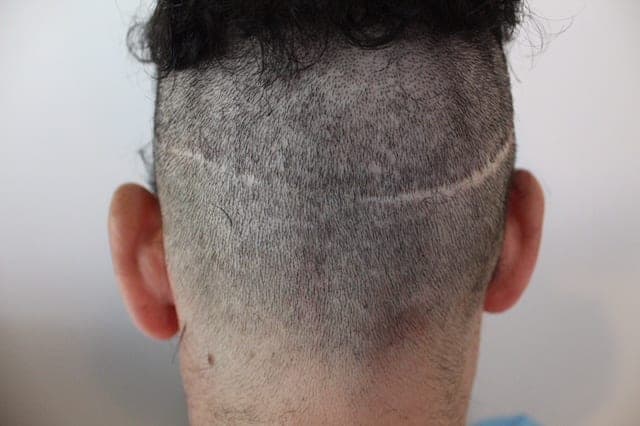 Patient with NW 3 level hair loss, FUE Shave test positive, nape and periauricular hair shows gradual progression from the mid occipital zone in terms of density, and hair caliber with no clear line of demarcation
