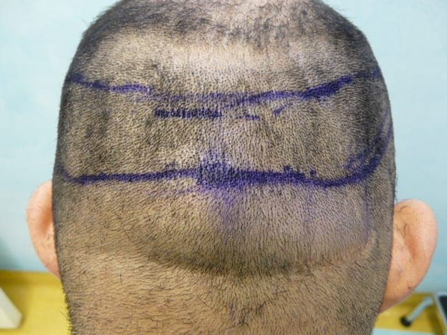 Patient with NW 4-5 level hair loss (back view), FUE Shave test negative, nape and periauricular hair shows a precipitous fall from the mid occipital zone in terms of density, and hair caliber with a discernible line of demarcation. Also shown is his neck showing usable donor hair.Also note how his occipital notch which would have fallen within the traditional safe donor zone is clearly in the retrograde alopecia zone in this FUE shave test illustration