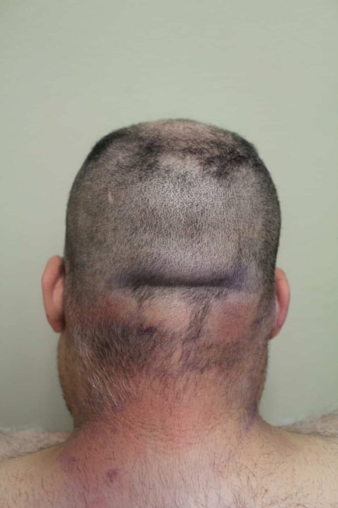Patient with Thinning in NW 5-6 area with retrograde alopecia after head shaving. Retrograde alopecia is well demarcated and his neck hair which is part of his body hair is intact