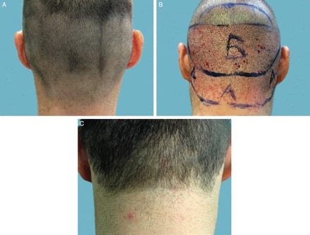 Patient with NW 3 level hair loss, FUE Shave test positive, (Before -A, Soon After FUE - B and at 9 months after FUE harvesting of Nape hair - C) In photo A, nape and periauricular hair shows gradual progression from the mid occipital zone in terms of density, and hair caliber with no clear line of demarcationIn photo B, The nape and periauricular zones are extracted optimally
In photo C, Healing is seemless at 9 months