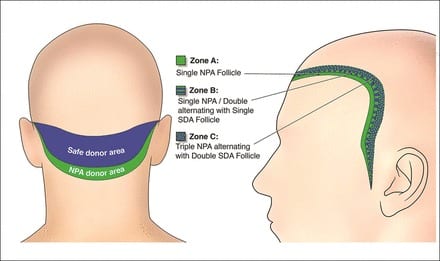 Schema, showing from study how the NPA and traditionally define SDA grafts were distributed in the recipient by Dr Umar in his study protocol published in the Aesthetic Surgery Journal in 2015