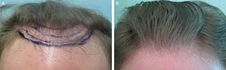 Use of Nape and periauricular hair enables the crafting of the most natural looking hairlines as shown in this patient for Dr U