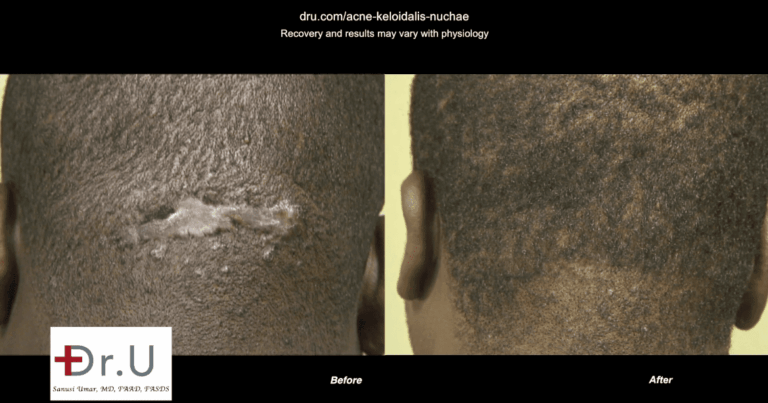 Before and after images of Dr.U's patient who underwent Acne Keloidalis Nuchae removal with Trichophytic excision and closure