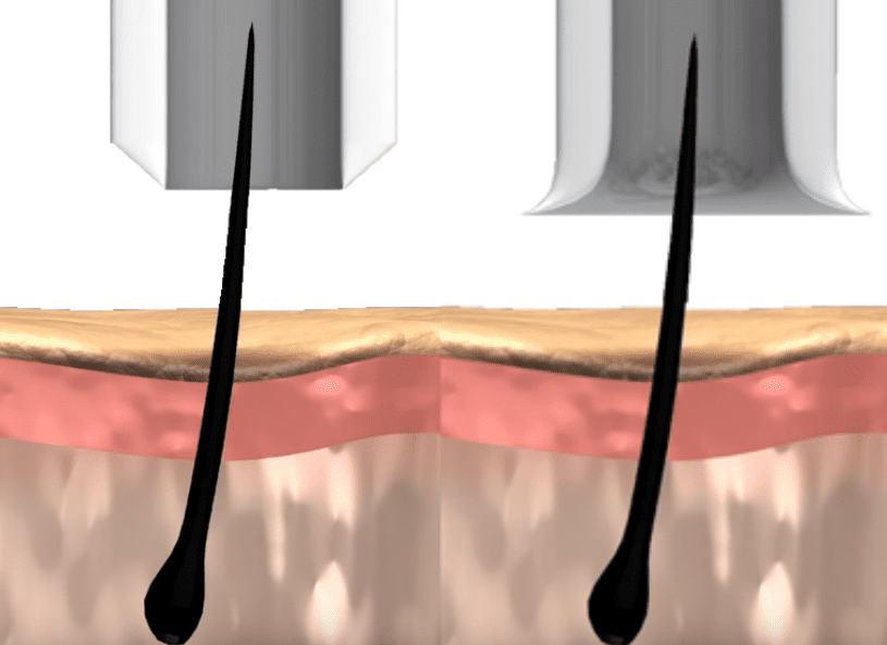 Many different FUE punch types exist. But patients need to pay attention to what problems they solve for their final results.