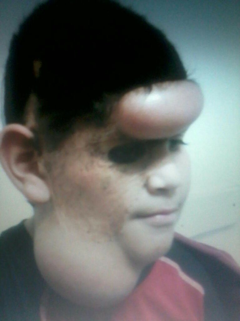 Patient shown undergoing balloon expansion which aims to stretch the skin and create extra tissue for replacing the congenital nevus mole areas on the face 
