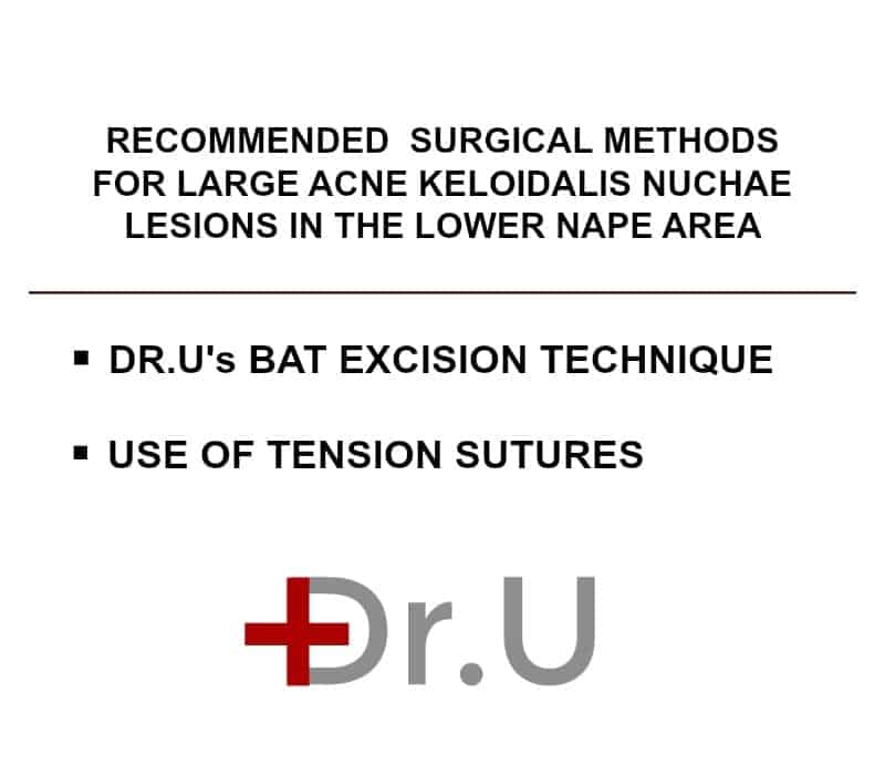 The use of Dr.U's bat excision technique helps to ensure a straight linear scar aligned with the posterior hairline. Tension sutures allow the surgeon to exert control over the wound closure process The use of Dr.U's bat excision technique helps to ensure a straight linear scar aligned with the posterior hairline. Tension sutures allow the surgeon to exert control over the wound closure process