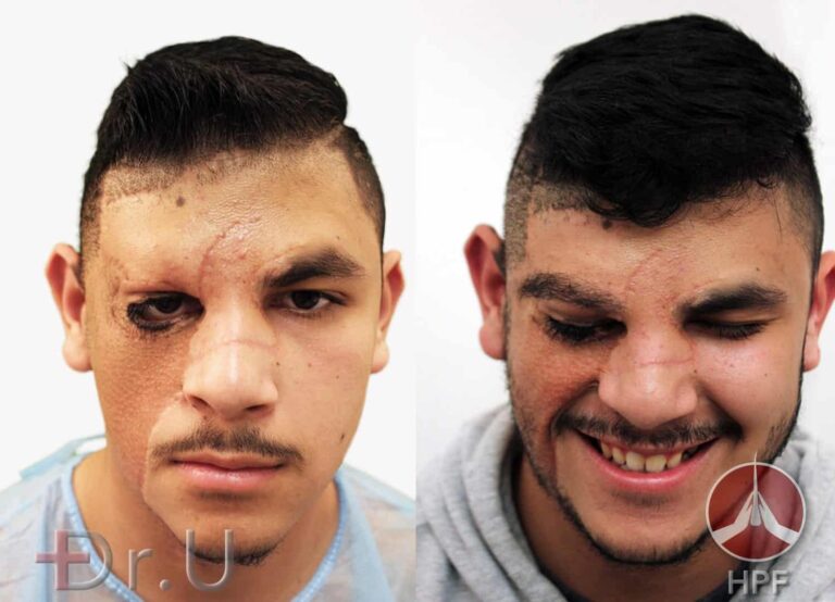 Los Angeles eyebrow and beard hair restoration - before and after photos showing the results of nape and leg hair transplant