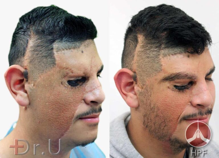 Before and after photos of Dr.U's sideburn hair transplant on right side of patient's face