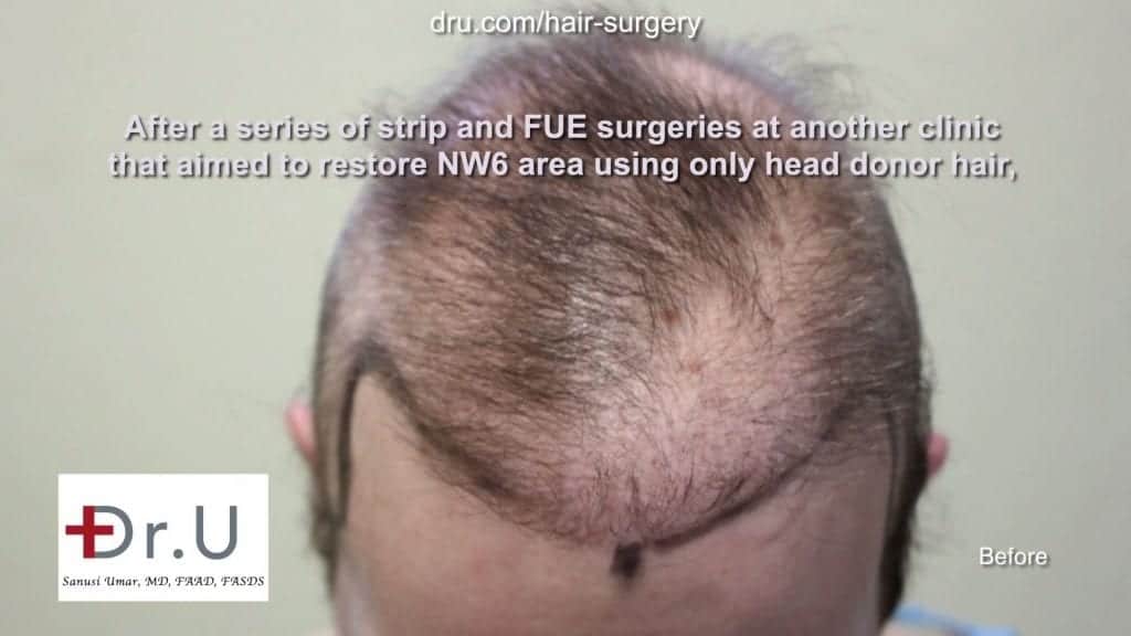 Choosing cost-effective options for hair transplant surgery must include qualified clinics with credentialed staff members. This will help to avoid the risk of botched, or unsafe surgical outcomes