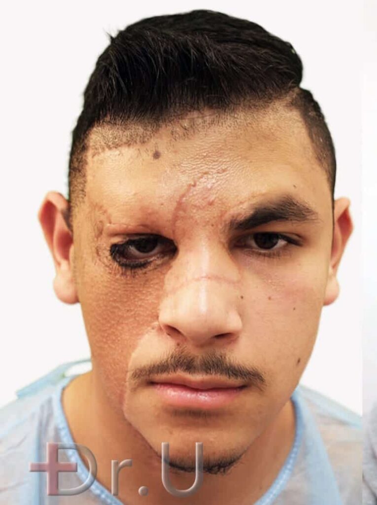 Patient shown with missing left eyebrow due to the placement of a skin graft on his forehead