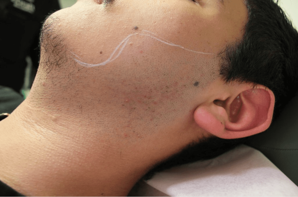 Facial hair transplantation on the left side of the face will advance and improve the contours of the patient's existing beard region 