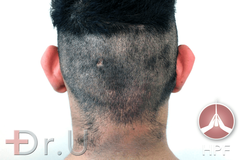 Dr.U's FUE Shave Test results show an even distribution of hair throughout the scalp. This patient, therefore, qualified for the long-term use of nape hair for his eyebrow and beard transplant procedure 