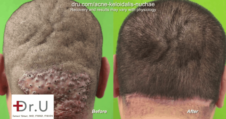 In this instance, secondary intention healing was used, allowing the wound to heal without suturing the edges together. Unlike the conventional context of secondary intention healing, the wound edges are brought together instead of allowing the process of granulation tissue to develop In this instance, secondary intention healing was used, allowing the wound to heal without suturing the edges together. Unlike the conventional context of secondary intention healing, the wound edges are brought together instead of allowing the process of granulation tissue to develop