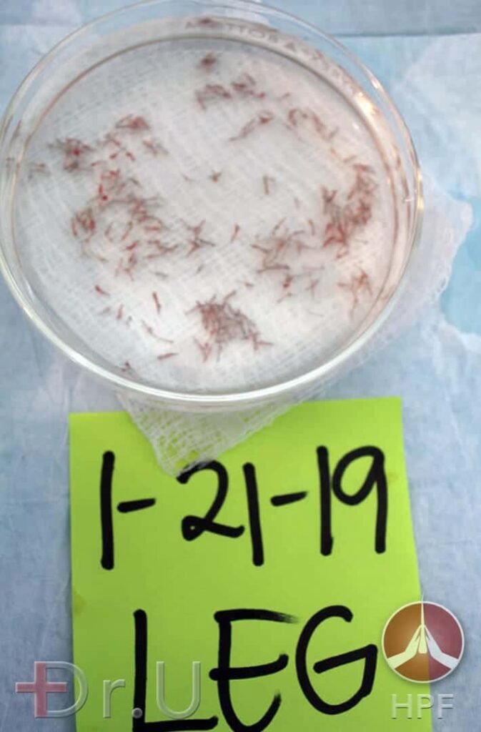 Photo of leg hair grafts safely extracted with the Dr.UGraft Intuitive FUE system. These were used for this patient's eyebrow reconstruction surgery and facial hair transplantation