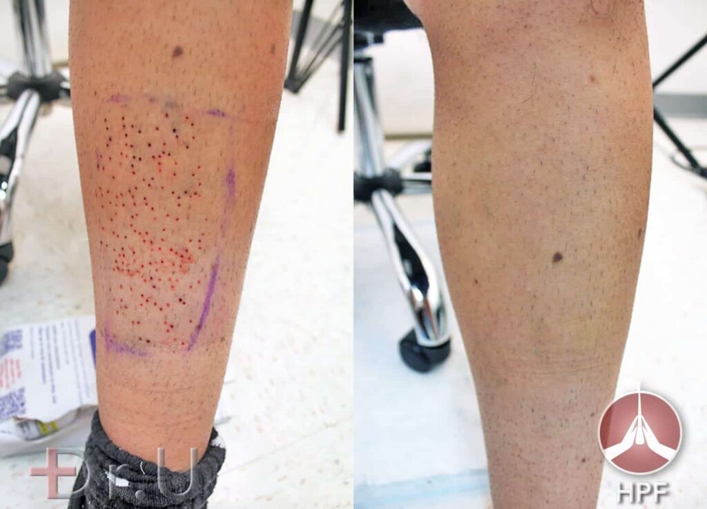 Before and after photos show excellent healing of patient's leg which helped supply donor grafts for this eyebrow and beard transplant procedure