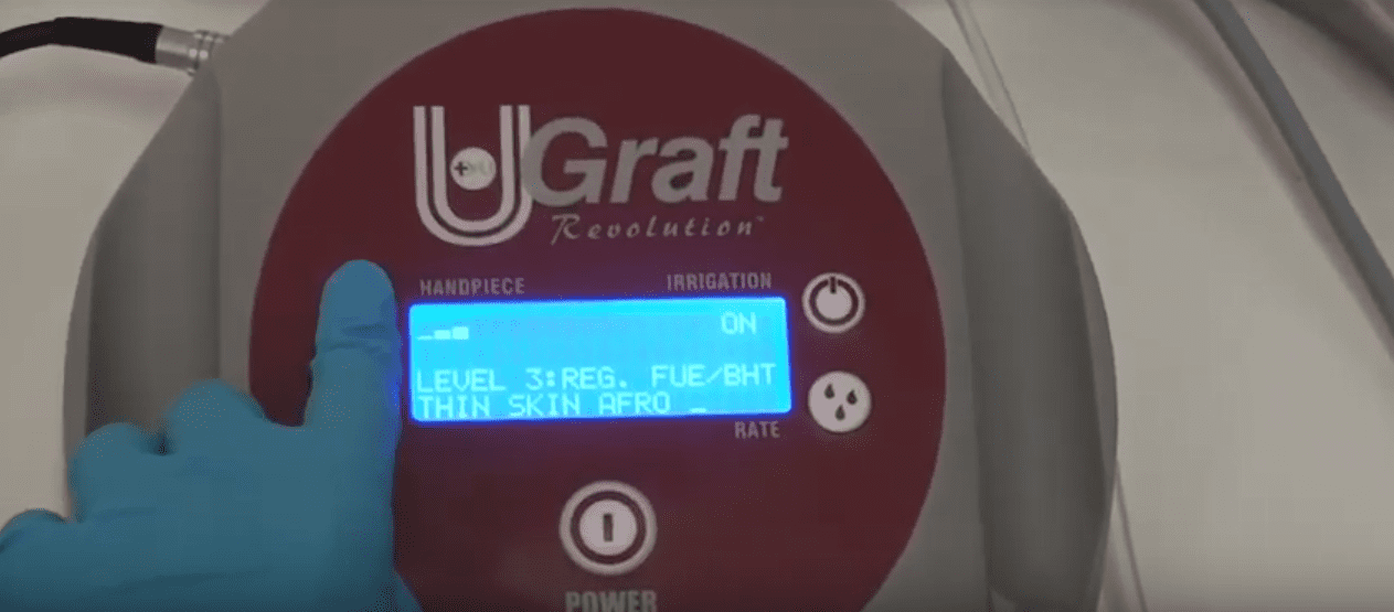 The Dr.UGraft Intuitive FUE technology offers the ability to customize both the speed and the torque of the punch's rotation to best suit the skin thickness of individual patients. 