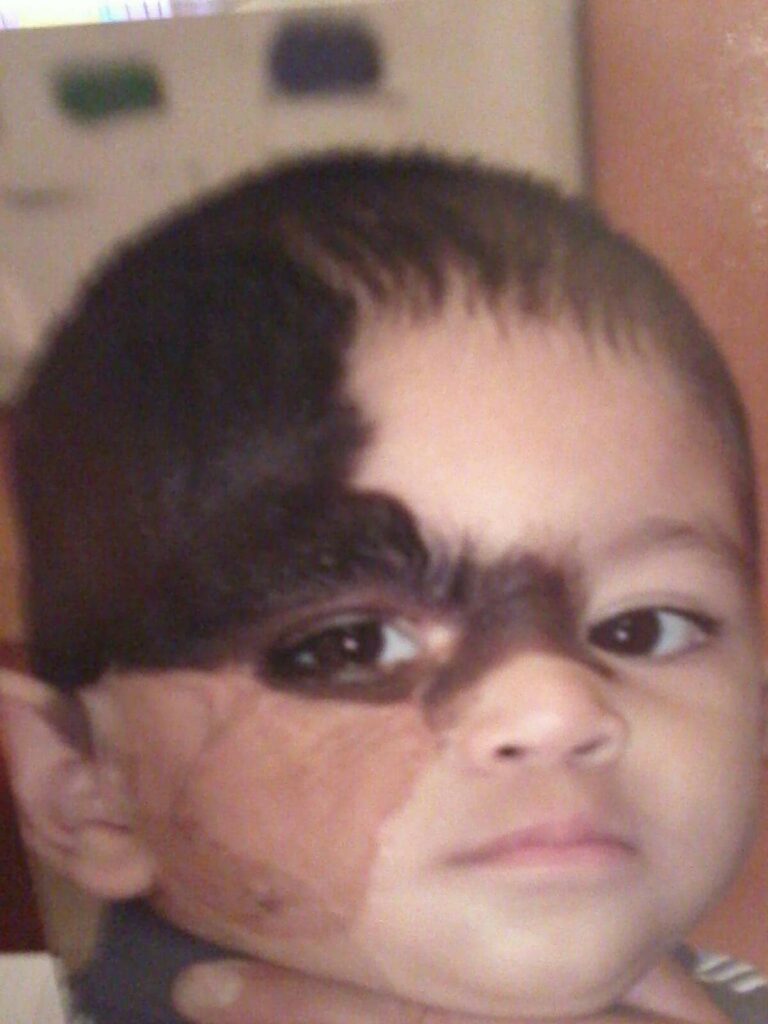 Los Angeles patient was born with a congenital nevus, undergoing several plastic surgeries to remove sections of the darkened skin. 