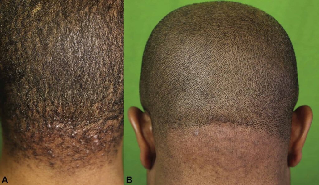 Example of level 1 patient in Dr.U's classification system for laser AKN treatment*
