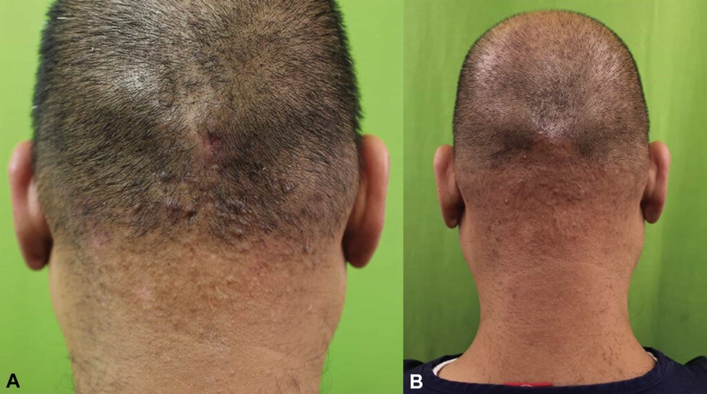 Example of level 2 AKN patient within Dr .U's patient classification system for laser treatment*