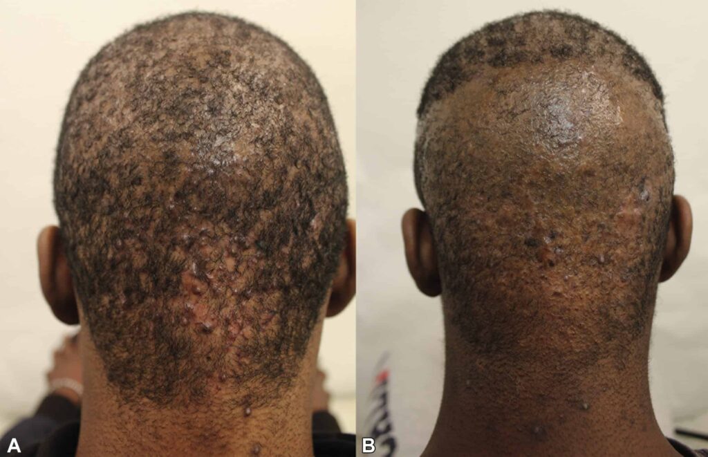 Example of AKN patient at level 3 in Dr. U's patient classification system for laser treatment*