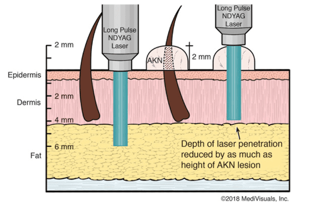 Illustration of the depth of penetration which can be achieved by the Nd: YAG laser for AKN treatment*