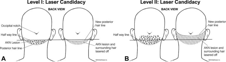 AKN laser treatment - defining two patient types