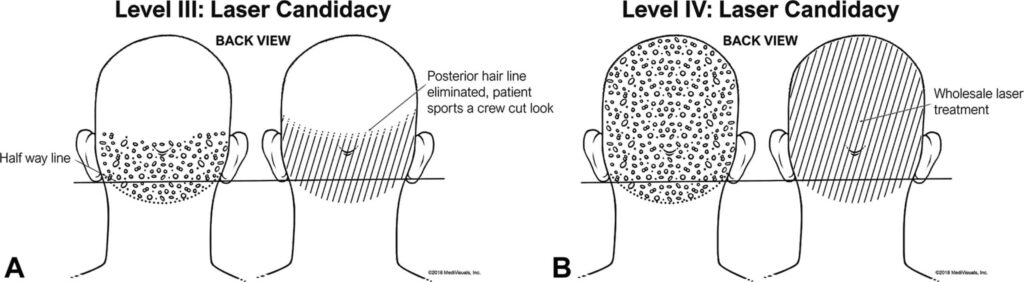 Diagram of AKN manifestations that qualify for laser treatment at levels 3 and 4 of Dr. U's patient classification system. At level 3, the bumps extend further up the scalp, past the halfway line. At level 4, the bumps have spread throughout the back of the head.*
