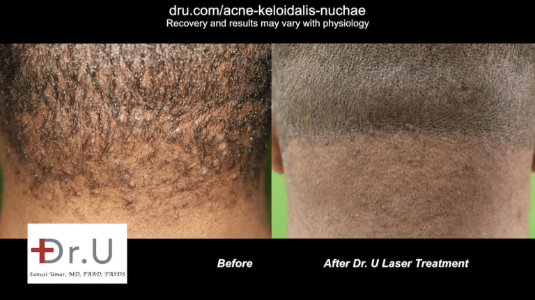 Patient before and after laser treatment for early-stage Acne Keloidalis Nuchae (AKN) Patient before and after laser treatment for early-stage Acne Keloidalis Nuchae