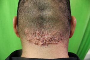 AKN Bumps - Note the plaquelike growth of acne keloidalis nuchae on the back of this patient's neck.