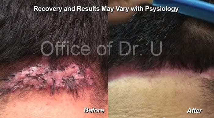 Dr. U surgically excised this patient's case of AKN, using his unique excision methods with suture-assisted 2nd intention healing for the wound to heal into an aesthetically acceptable scar.*