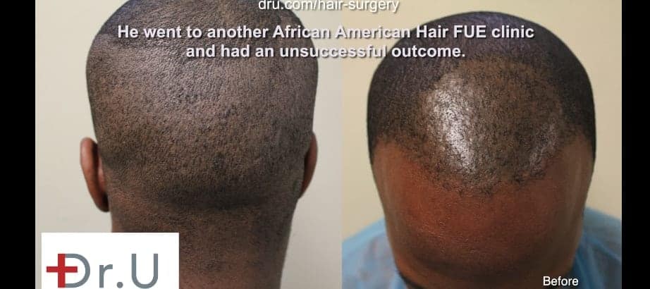 African American Curly hair UGraft FUE using 1400 grafts