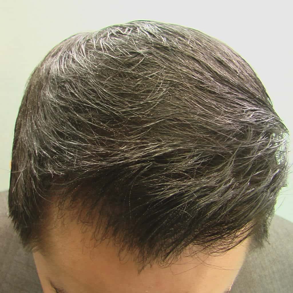 Asian hairline restoration using Dr UGraft in Los Angeles