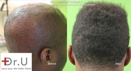 Before and After: FUE for hair restoration in black African men Before and After: FUE for hair restoration in black African men