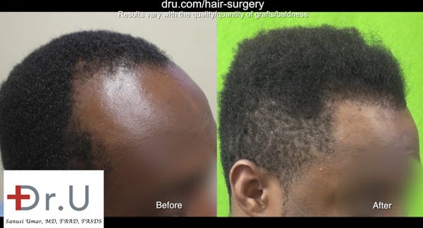 African American hair transplant before after results of the Dr UGraft procedure African American hair transplant before after results of the Dr UGraft procedure