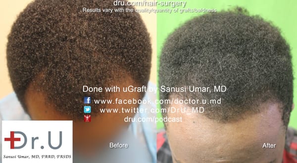 Dr. Umar used 1600 grafts for black hair restoration Dr. Umar used 1600 grafts for black hair restoration