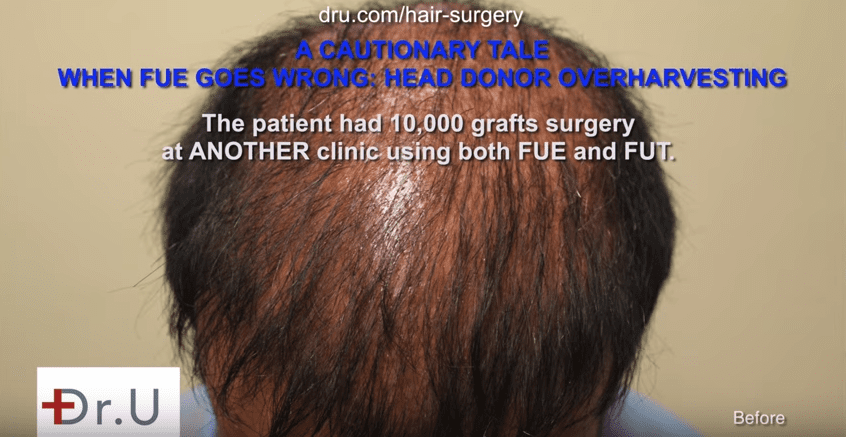 The results of bad FUE hair transplant planning after 10,000 grafts surgery at another clinic*