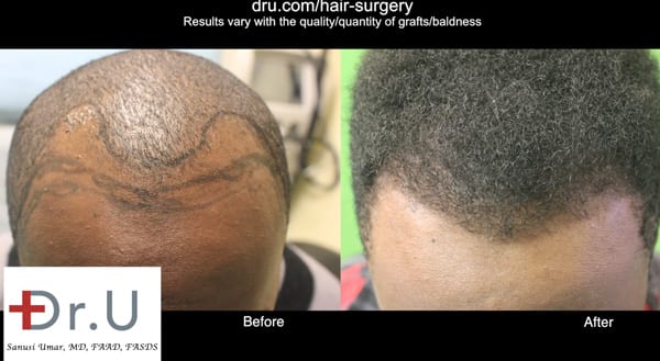 Hairline restoration in a patient of African descent Hairline restoration in a patient of African descent
